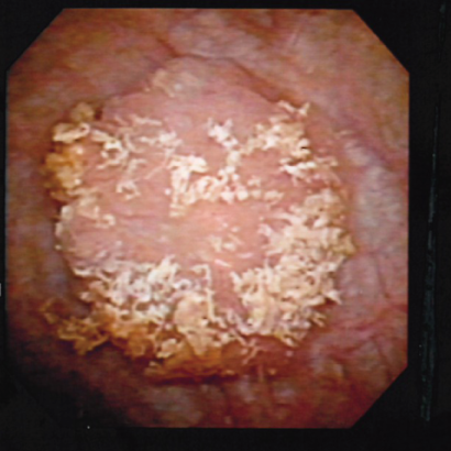 膀胱腫瘍の症例01 手術前